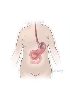 ORBERA Procedure Placement