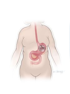 ORBERA Procedure Placement