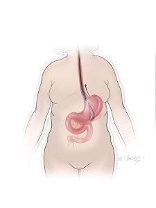 ORBERA Procedure Removal